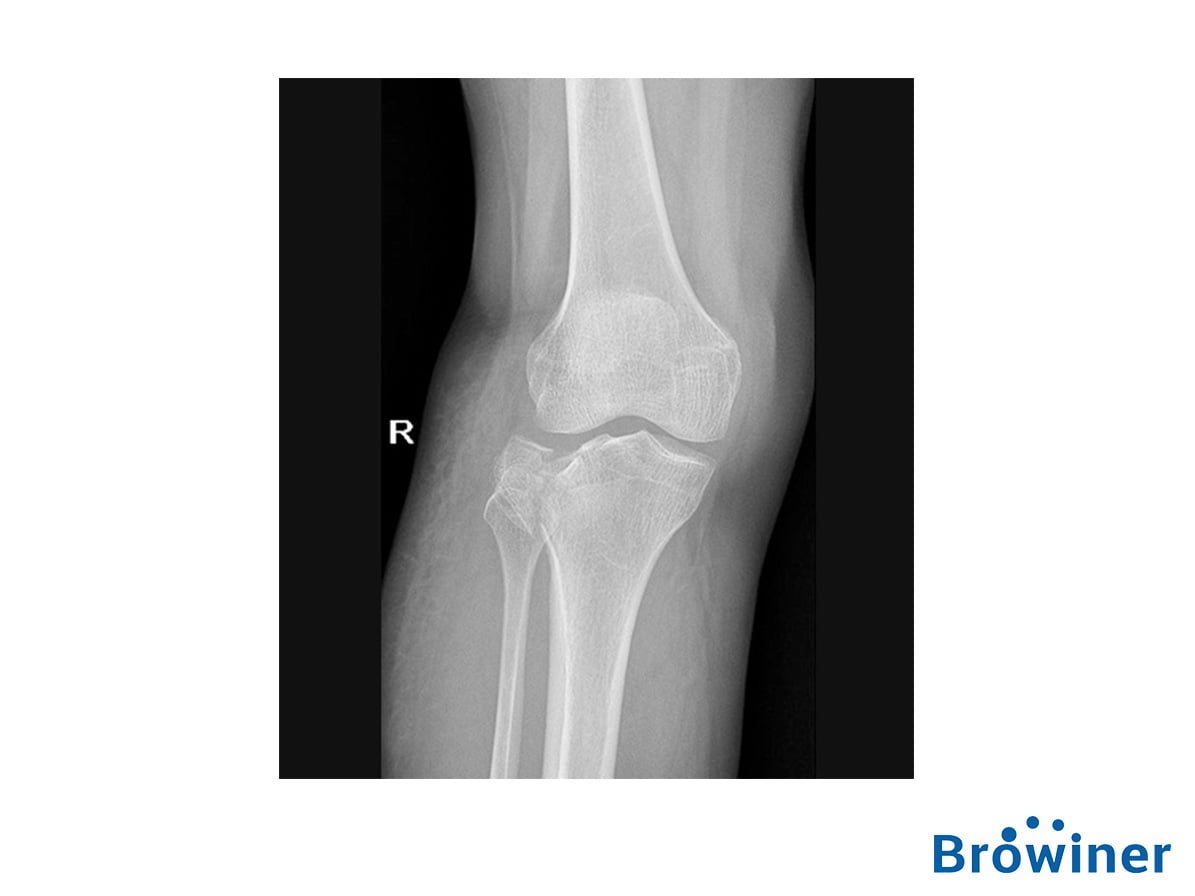 Rayos-X Portatil Battle 05P marca Browiner. Comercializado en colombia por B&E Ingeniería médica.
