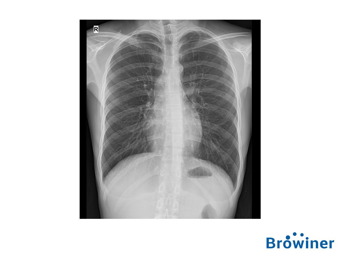 Rayos X Browiner Mobile Cooper. Comercializado en Colombia por B&E Ingeniería Médica.