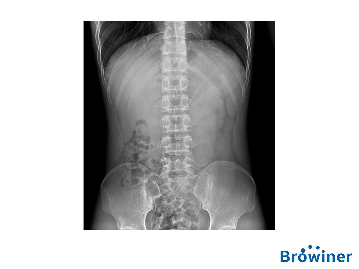 Rayos X Browiner Mobile Cooper. Comercializado en Colombia por B&E Ingeniería Médica.