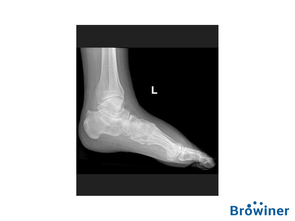 Rayos-X portátil mobile sparkler de la marca Browiner. Comercializado en Colombia por B&E Ingeniería Médica.